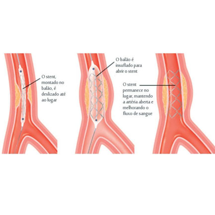 Cirurgia Endovascular