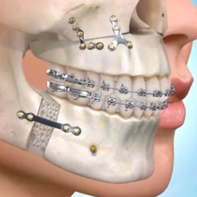 Cirurgia e Traumatologia Buco-Maxilo-Facial